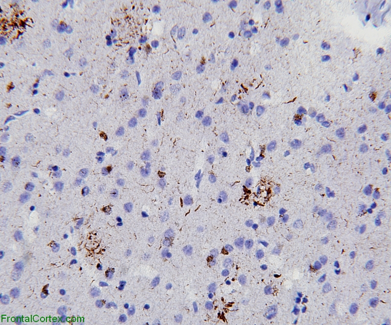 AD Occipital Neocortex Tau IHC